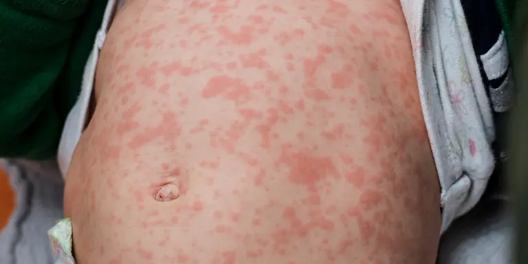 New measles case puts Byron Bay on alert
