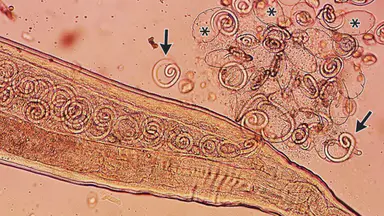 Worms mate in man's eyes, get plucked out right before larvae burst out