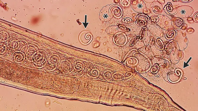 Worms mate in man's eyes, get plucked out right before larvae burst out