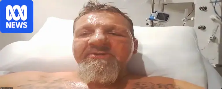 Patient speaks after being set on fire at Sydney hospital