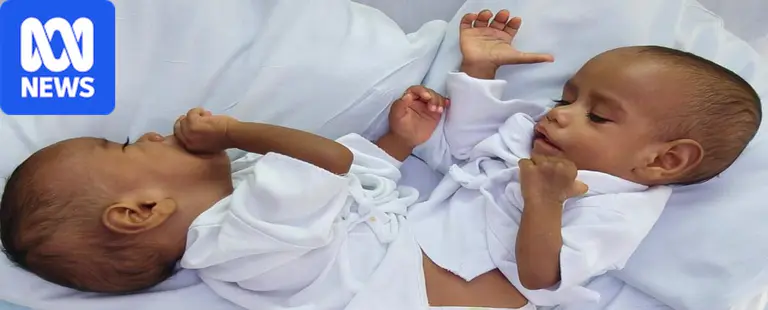 Fijian conjoined twins successfully separated in 'exceptionally rare' case